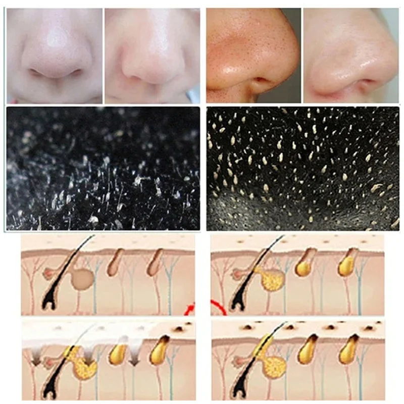 10 pçs tiras de cravo nariz li - Cleanser Face avaliação e preço